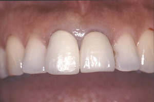 【術前】上顎両側前歯2本に不良修復物が装着され審美障害を訴えられている症例。