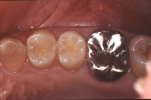 【術前】上顎左側臼歯に金属の修復物が装着され審美障害を訴えられている症例の術前。