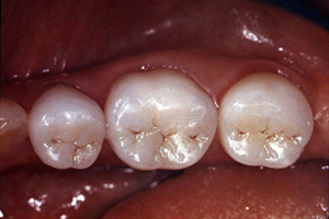 【術前】下顎右側臼歯3本に装着されているセラミッククラウン症例。人工的な色調のクラウンで自然観に乏しい。