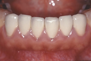【術前】下顎前歯部に形態不良なセラミッククラウンが装着され歯周組織(歯茎)が慢性の炎症を引き起こしている症例。