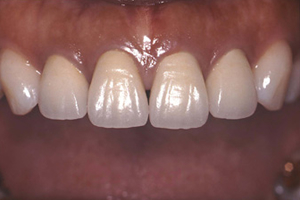 【術前】上顎前歯4本にセラミッククラウンが装着されている症例。左右の形態に対称性がなく歯茎との境に隙間が存在しています。
