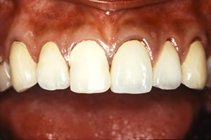 【術前】上顎前歯6本にセラミッククラウンが装着され歯茎の退縮と共に審美障害を訴えた症例。