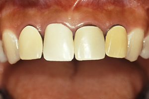【術前】上顎前歯4本に不良修復物が装着され審美障害を訴えられている症例。