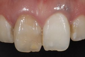 【術前】右側1番目の歯の神経が失われて数年経過したことにより変色し、審美障害を主訴に来院された初診時の状態です。