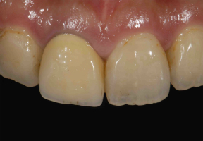 【術前】右側1番目の歯に修復物が装着されていますが、金属を用いた修復物であることにより歯ぐきとの境界が不自然に黒ずんで審美障害を主訴に来院された初診時の状態です。
