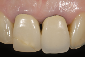 【術前】両側1番目の歯に古い修復物が装着されており、審美障害を主訴に来院された初診時の状態です。