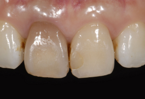 【術前】両側1番目の歯の神経が失われて長期間経過したことにより変色し、審美障害を主訴に来院された初診時の状態です。