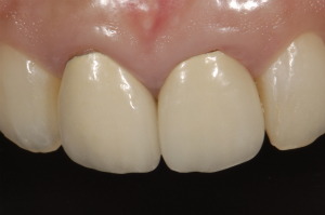 【術前】両側1番目の歯に不適合な古い修復物が装着されており、歯ぐきとの境界が不自然に黒ずんでいる審美障害を主訴に来院された初診時の状態です。