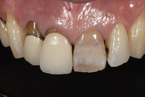【術前】右側2本に不適合な修復物が装着されており、左側1番目の歯は神経を失って長期間経過したことにより変色の審美障害を主訴に来院された初診時の状態です。