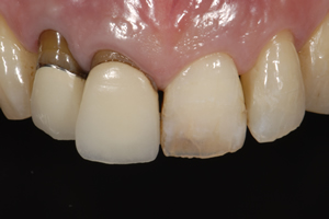 変色している左側の歯を漂白して色調を整えます。