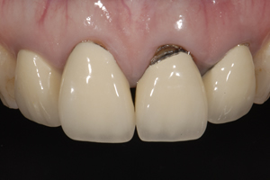 【術前】前歯4本に不適合な修復物が装着されており、審美障害を主訴に来院された初診時の状態です。
