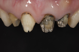 その不良修復物を除去したところ、広範囲にわたり虫歯が進行していました。